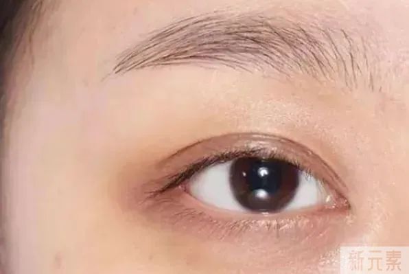 对付这两种黑眼圈，别再浪费眼霜了! 图片-6