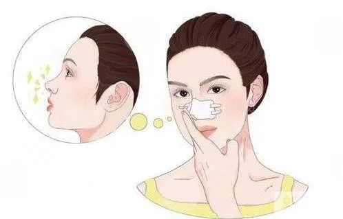 硅胶隆鼻和膨体隆鼻有啥区别? 图片-7