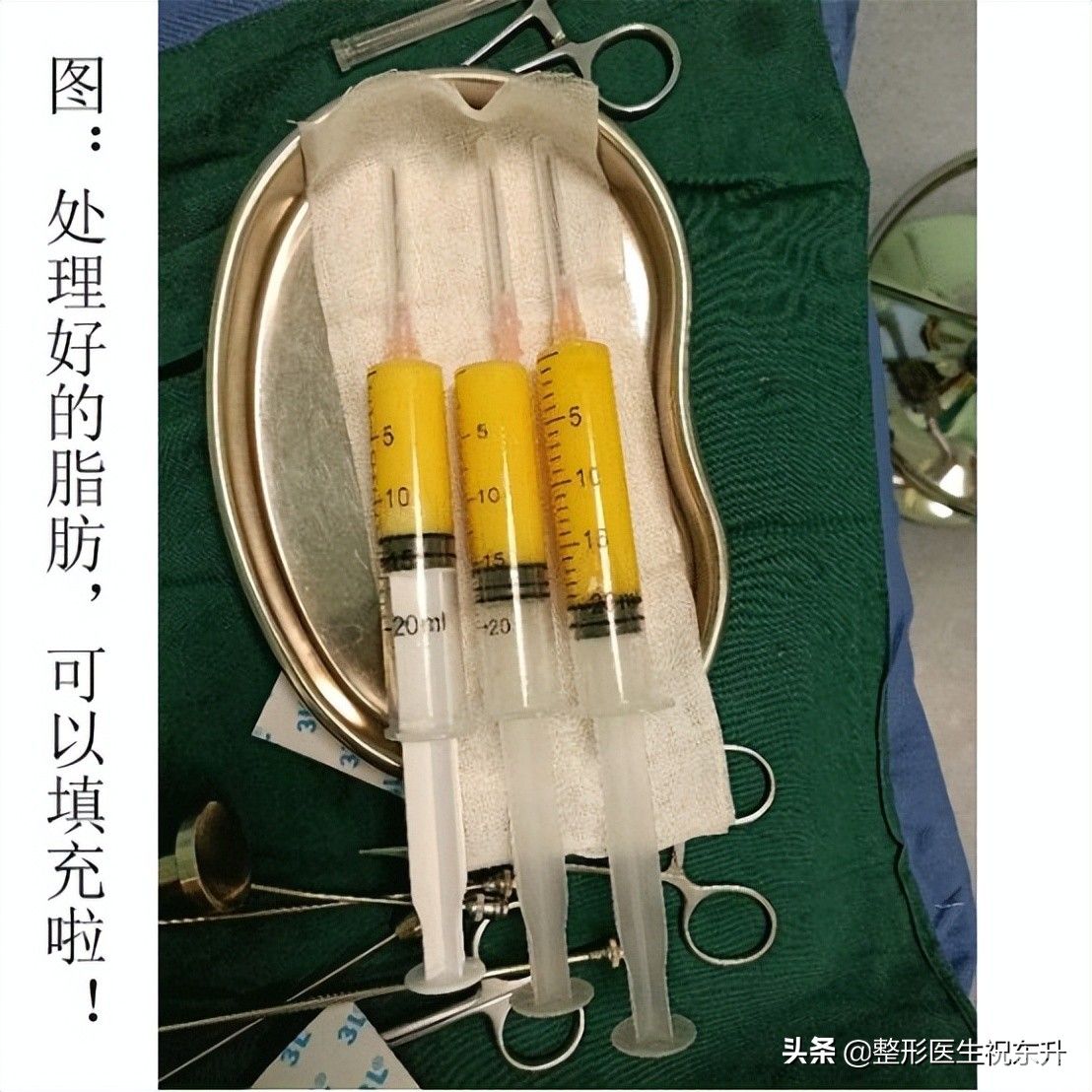 41岁做全脸脂肪填充，全程实拍大公开，这娃娃脸真“绝”了 图片-4