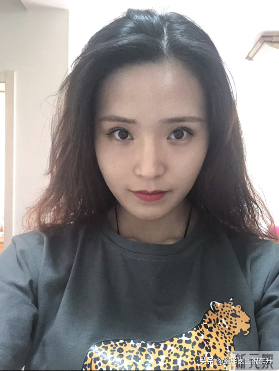 41岁做全脸脂肪填充，全程实拍大公开，这娃娃脸真“绝”了 图片-5