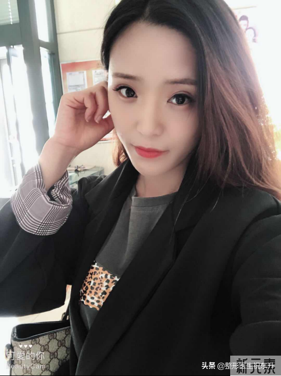 41岁做全脸脂肪填充，全程实拍大公开，这娃娃脸真“绝”了 图片-6