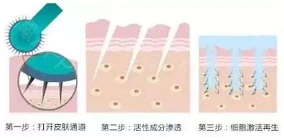 伊肤泉微针和水光针的区别是什么? 图片-3