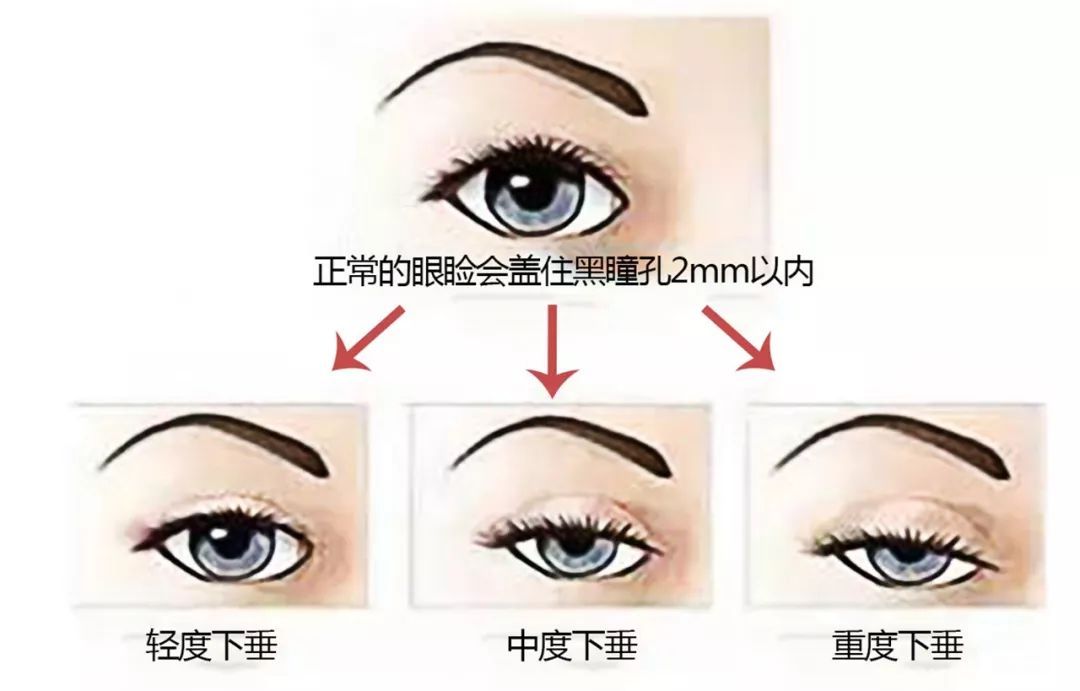 改善眼皮下垂，切开双眼皮和悬眉怎么选? 图片-4