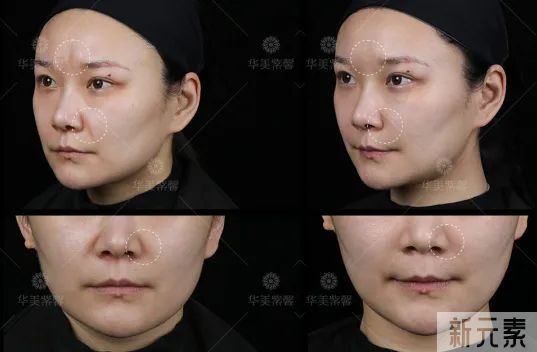 当今医美顶流仪器怎么选?看完这篇省几万! 图片-6