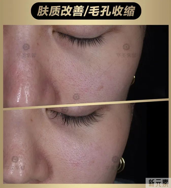 当今医美顶流仪器怎么选?看完这篇省几万! 图片-13