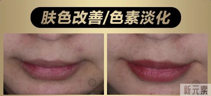 当今医美顶流仪器怎么选?看完这篇省几万! 图片-14