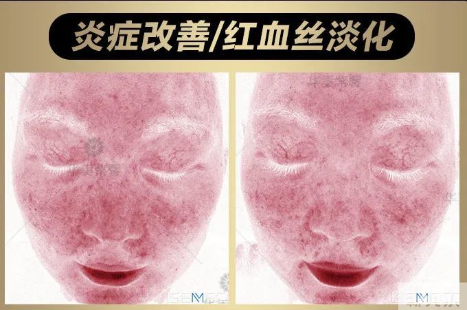 当今医美顶流仪器怎么选?看完这篇省几万! 图片-15