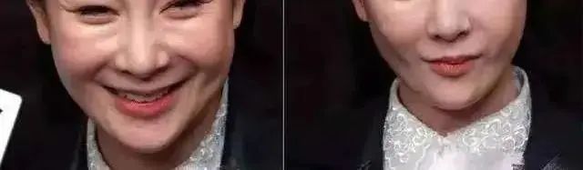 玻尿酸打多了笑起来像哭?看她就明白了... 图片-3