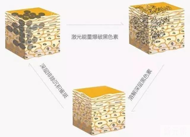哪些人不适合做皮秒祛斑? 图片-5