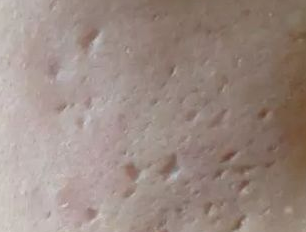 小心!你长的痘痘痤疮很可能会留下这2种疤痕 图片-4