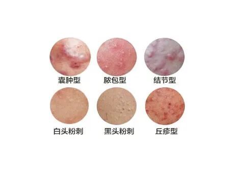 小心!你长的痘痘痤疮很可能会留下这2种疤痕 图片-2