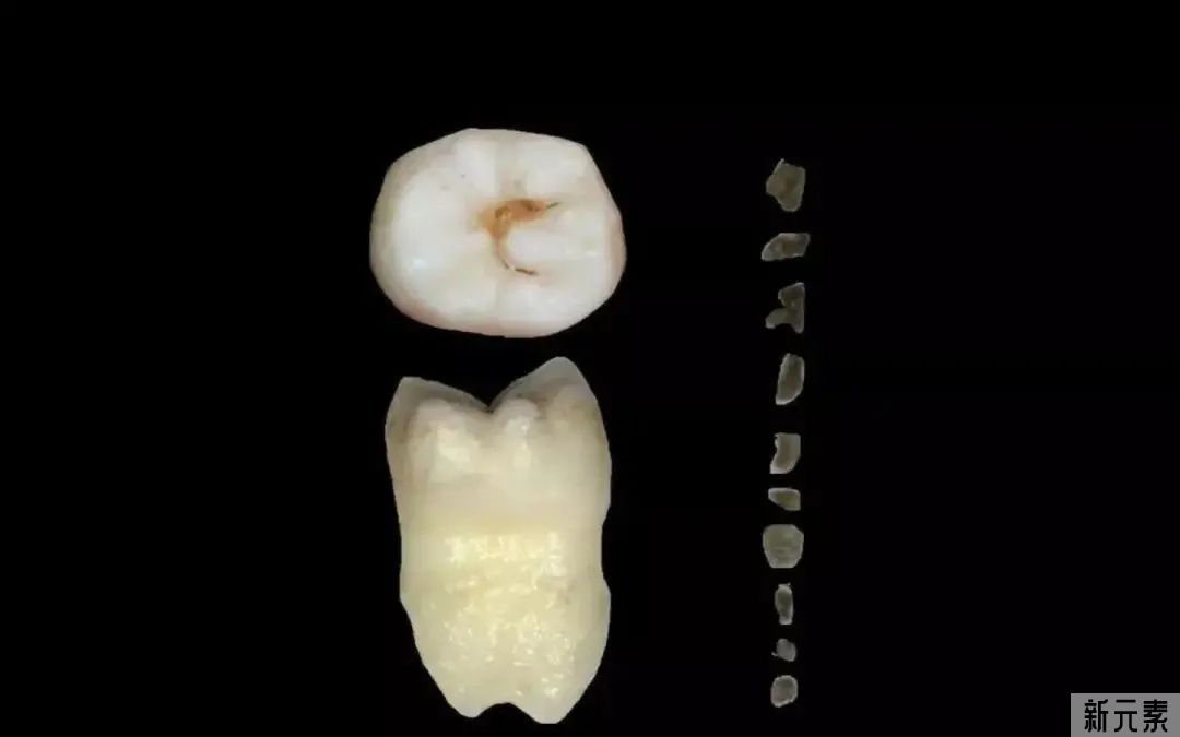 洗牙的真相是什么?专业口腔医生告诉你 图片-10
