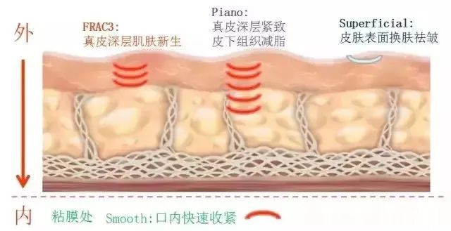 医美顶流紧肤仪器大全，看完省几万! 图片-5