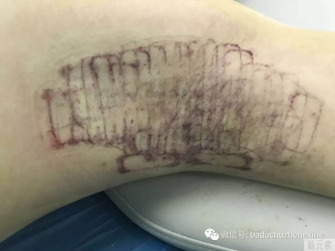 天气热了，尴尬的腋臭多汗症 图片-16
