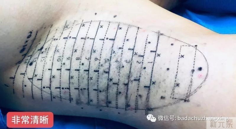 天气热了，尴尬的腋臭多汗症 图片-15