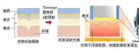 听说热玛吉很痛，是真的吗? 图片-2