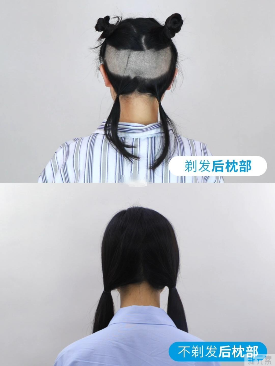 植发后怎么清理痂皮?自己可以动手清理吗? 图片-5