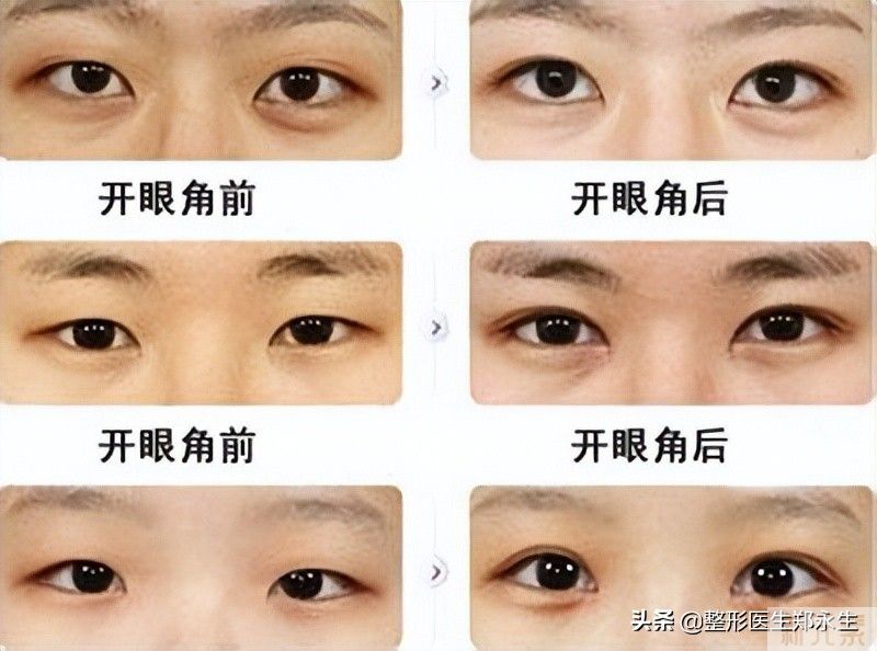 有内眦就必须开眼角吗?千万不要随便开眼角 图片-2
