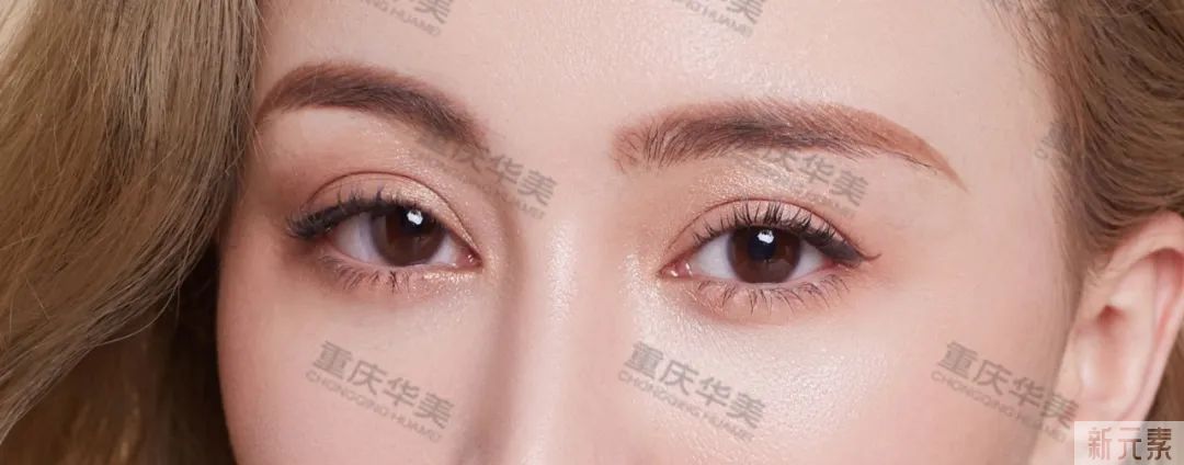 SOS!割了眼袋眼睛却凹陷了，这是咋个回事? 图片-3