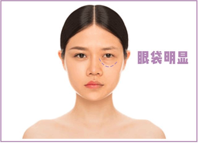 SOS!割了眼袋眼睛却凹陷了，这是咋个回事? 图片-2