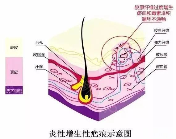 增生疤痕危害大，这些你都了解吗? 图片-7