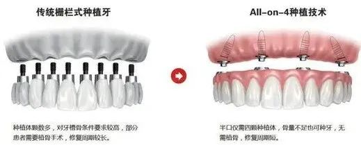 即刻种植VS传统种植，有什么区别，你更适合哪一个? 图片-4