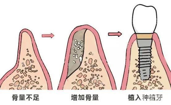 即刻种植VS传统种植，有什么区别，你更适合哪一个? 图片-8
