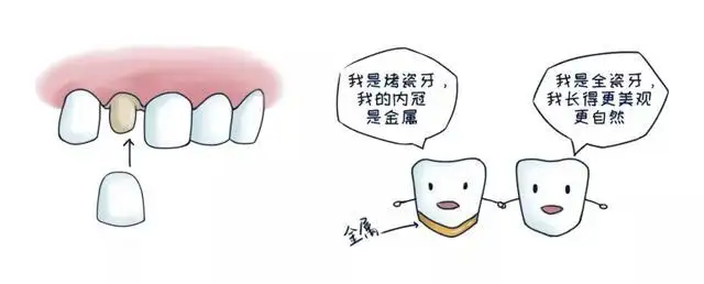 烤瓷牙和全瓷牙到底有什么不同?为什么现在医生都推荐全瓷牙? 图片-9