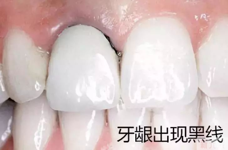 烤瓷牙和全瓷牙到底有什么不同?为什么现在医生都推荐全瓷牙? 图片-10