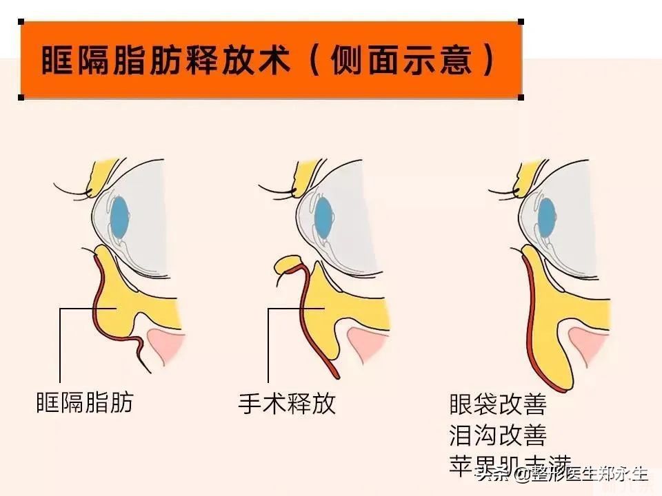 有眼袋人群必看，如何有效预防眼袋再次出现? 图片-2