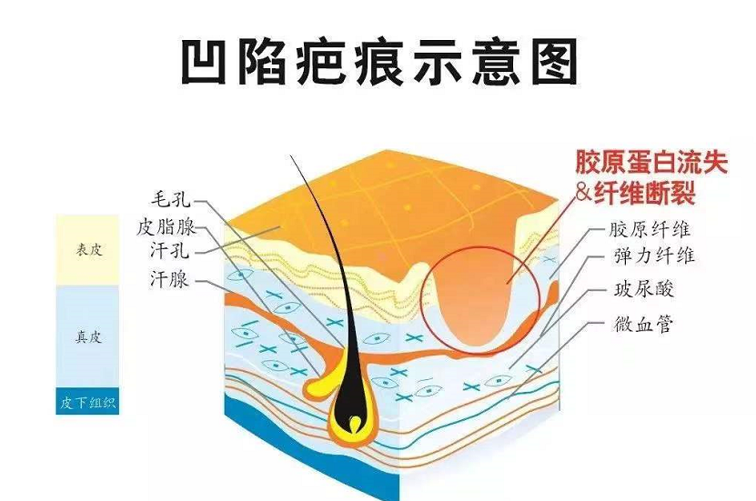 凹陷疤痕有这几种类型!你属于哪种呢? 图片-5
