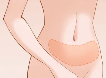 不想健身，却想拥有马甲线，想通过吸脂吸出马甲线? 图片-8