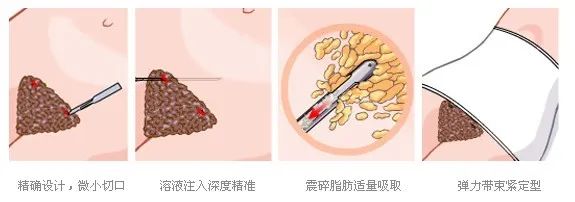 不想健身，却想拥有马甲线，想通过吸脂吸出马甲线? 图片-10