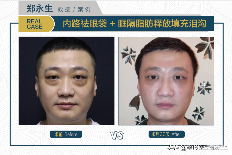 有眼袋泪沟的一定要看，瞬间年轻十岁 图片-2