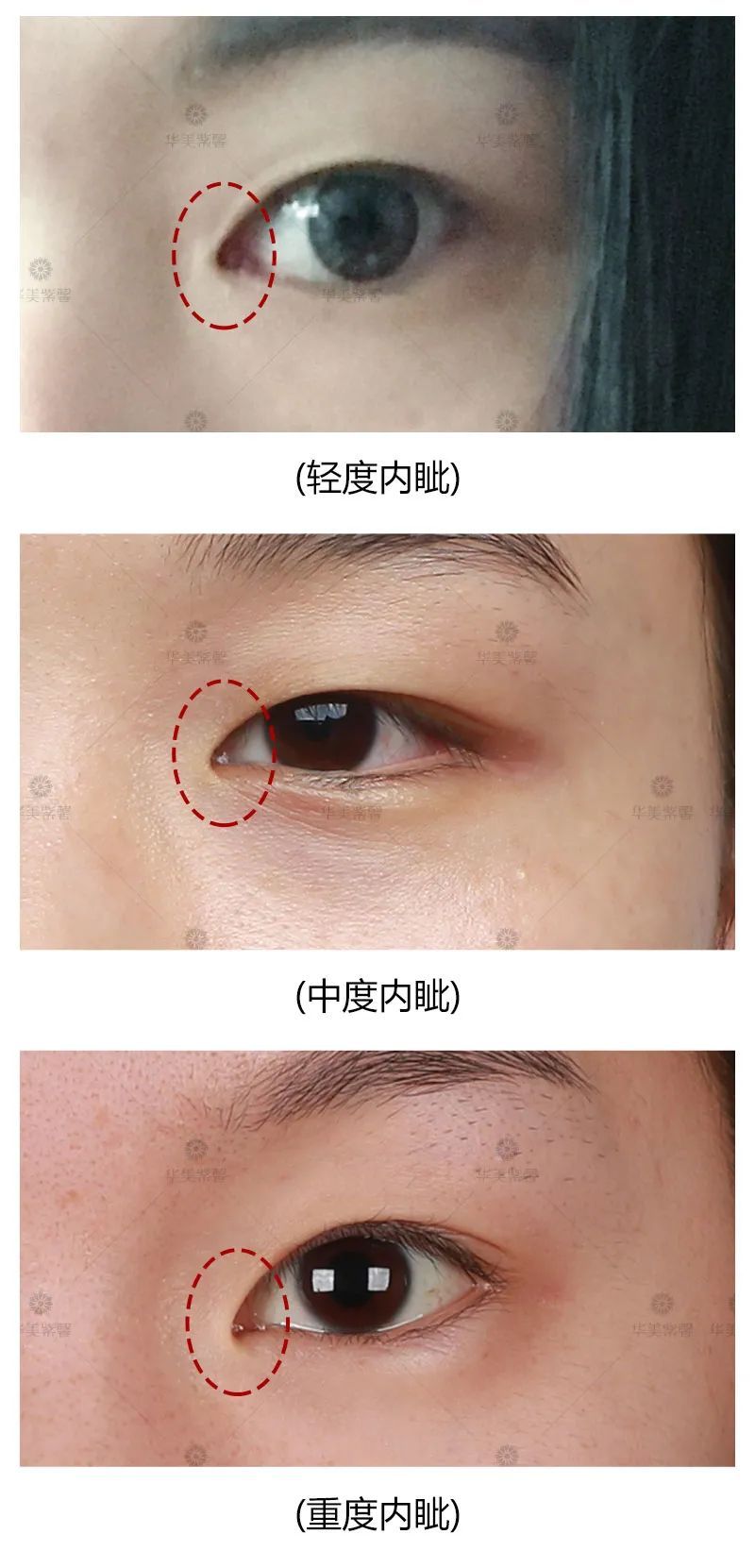 单眼皮有这5个特征，做双眼皮的钱都可以省了! 图片-9