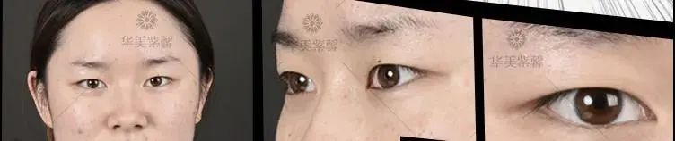 单眼皮有这5个特征，做双眼皮的钱都可以省了! 图片-7