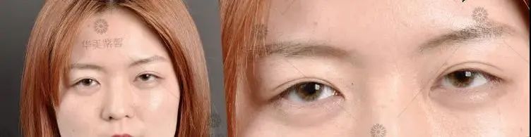 单眼皮有这5个特征，做双眼皮的钱都可以省了! 图片-11