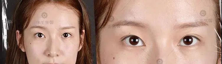 单眼皮有这5个特征，做双眼皮的钱都可以省了! 图片-15