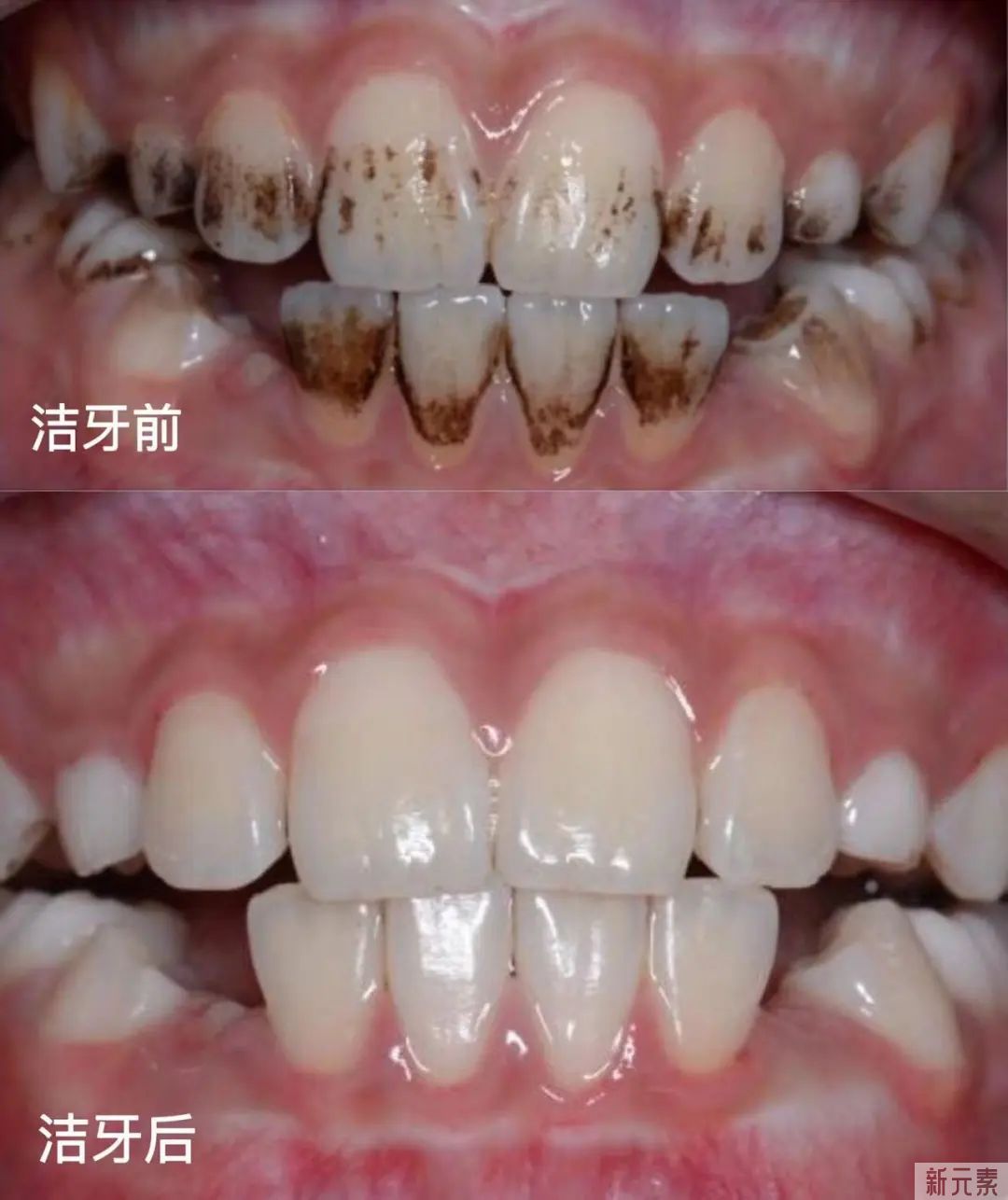 种牙先洗牙?注意，这可不是“多此一举”! 图片-12