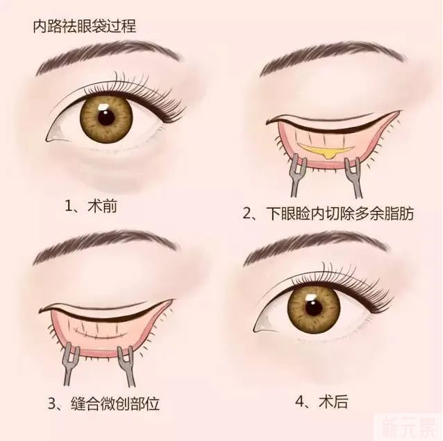 万年黑眼圈?老泪沟?眼袋?...这些眼周硬伤如何拯救? 图片-15