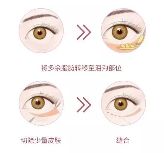 万年黑眼圈?老泪沟?眼袋?...这些眼周硬伤如何拯救? 图片-17