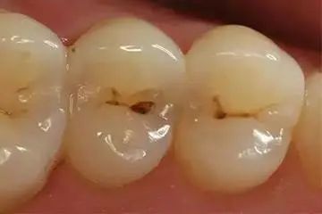 科普来了 | 这样的蛀牙，医生说不能补牙了...? 图片-12