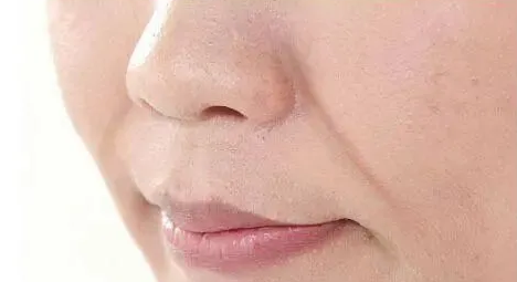 年纪轻轻居然有法令纹?看你属于哪一种? 图片-2