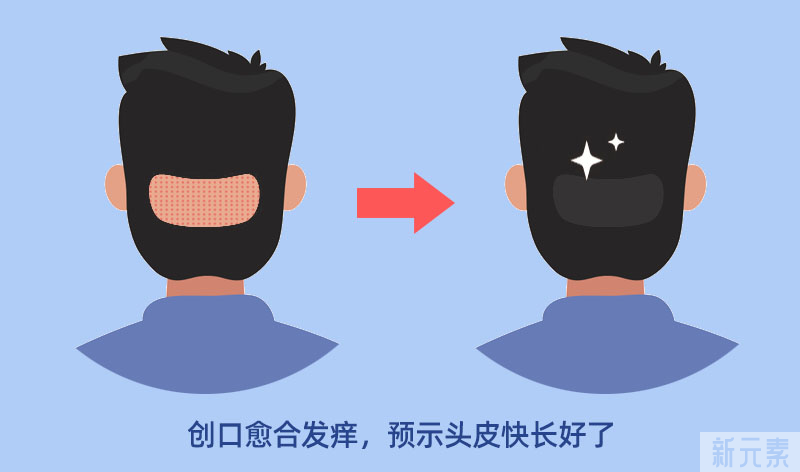植发后，头皮特别痒怎么办? 图片-2