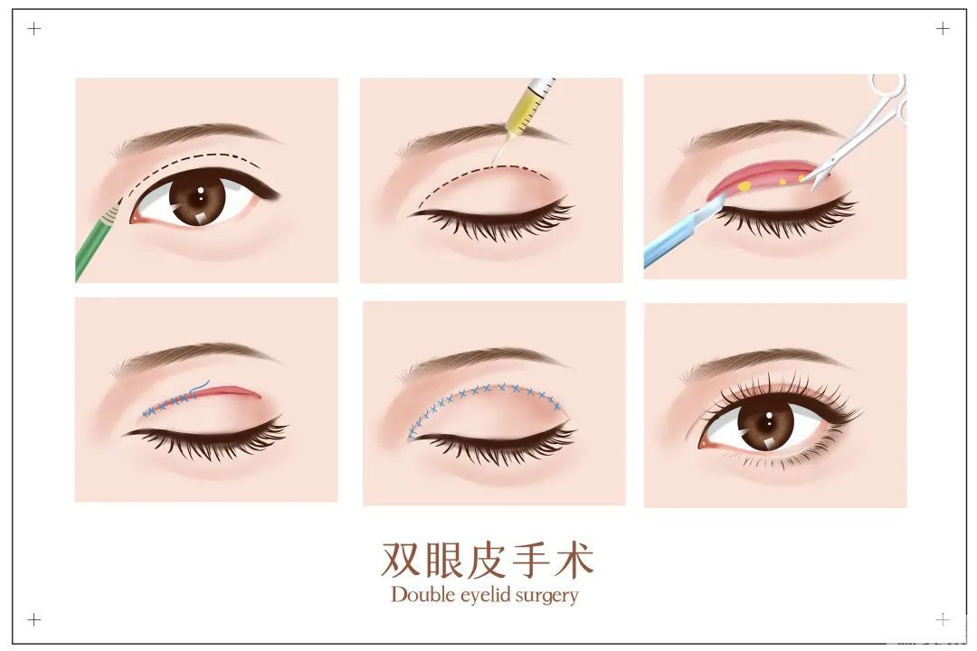 大小眼除了影响美观，背后还藏着这些··· 图片-6
