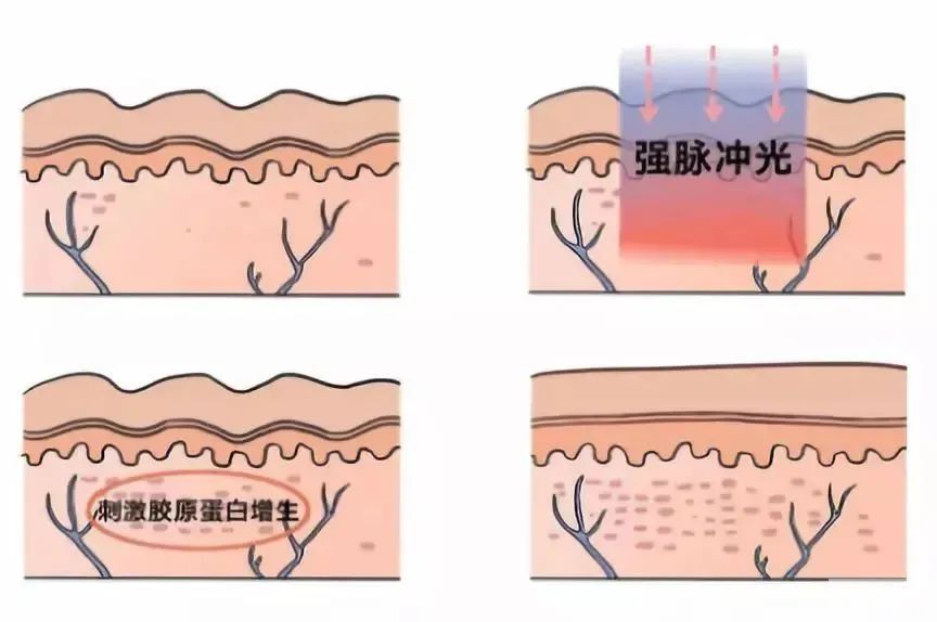 黄金超光子到底值不值得做?它和普通的光子嫩肤有何区别? 图片-9