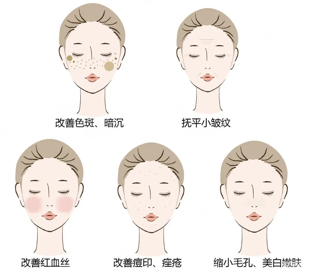 黄金超光子到底值不值得做?它和普通的光子嫩肤有何区别? 图片-35