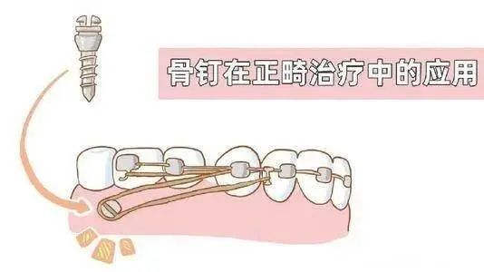 小身躯大作用，这个正畸利器了解下! 图片-4
