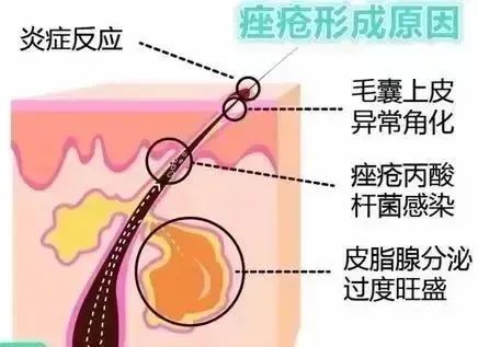 建议收藏丨果酸焕肤，油痘皮的小仙女赶紧打开看看! 图片-9