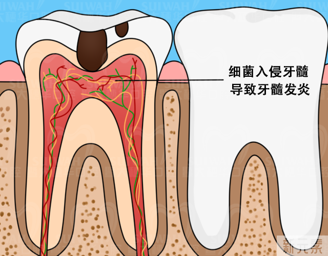 “虫牙”必经的5个阶段，越早知道越省钱! 图片-9